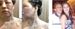 Vereadora Dudu Coelho ficou com o pescoço queimado Foto: divulgação